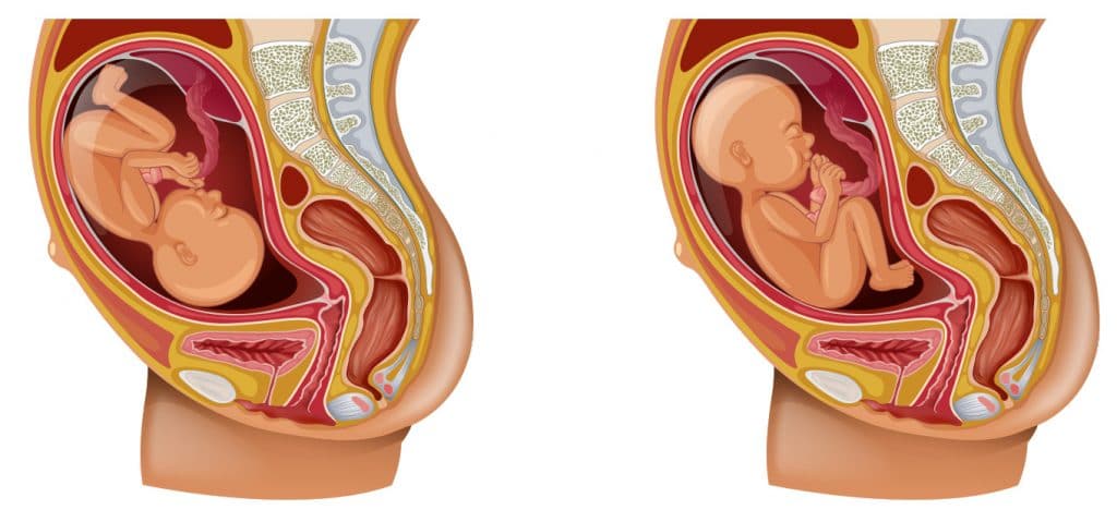 Beckenendlage-bel-vorzeitige-wehen-corona-und-schwanger